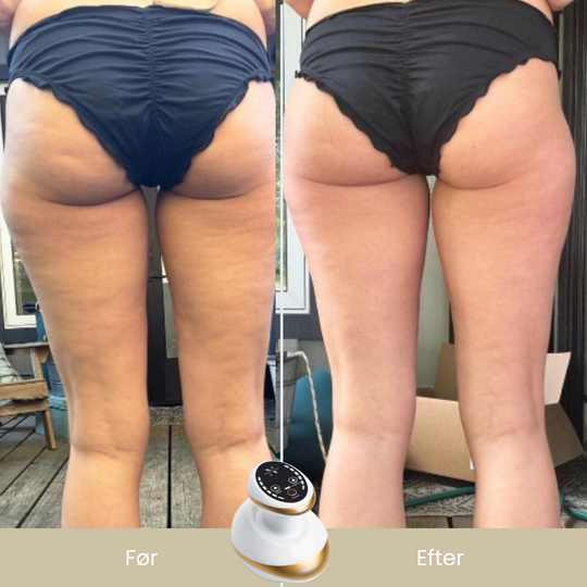 CelluSmooth™ - Anti cellulite massageapparat