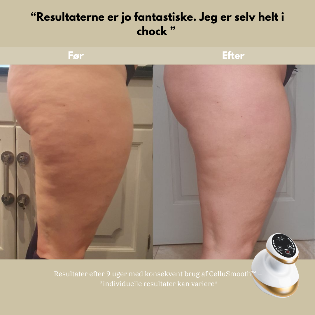 CelluSmooth™ - Anti cellulite massageapparat