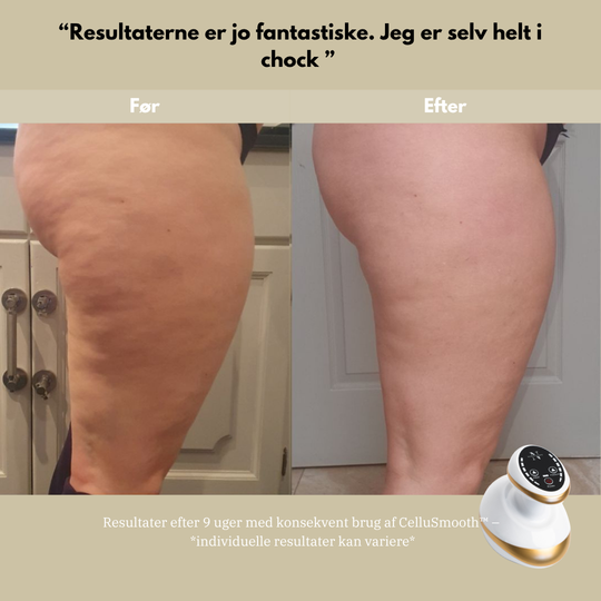 CelluSmooth™ - Anti cellulite massageapparat