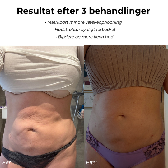 CelluSmooth™ - Anti cellulite massageapparat
